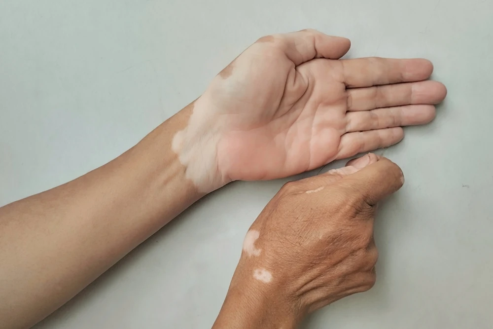 Vitiligo Tedavisinde Yeni Yaklaşımlar: Yalnız Değilsiniz