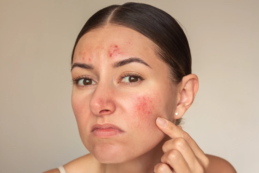 Egzama ile Mücadelede Doğal Destekler: Sadece Kremler Yeterli mi?