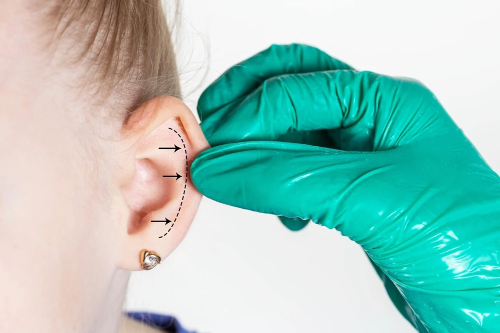 Kepçe Kulak Estetiği