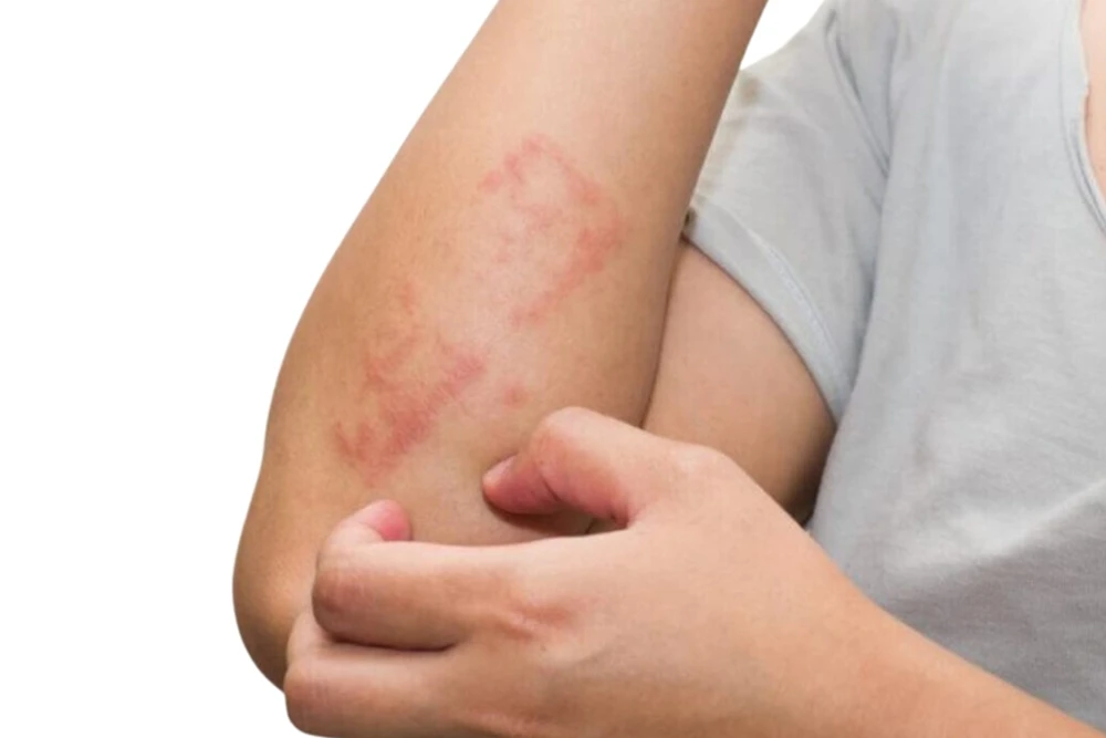 Liken Planus: Kaşıntı ve Lezyonlarla Gelen Sessiz Hastalık