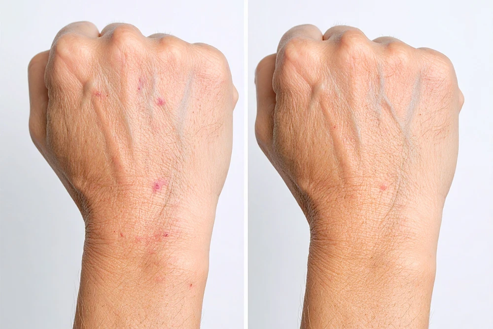 Liken Planus Tedavisi