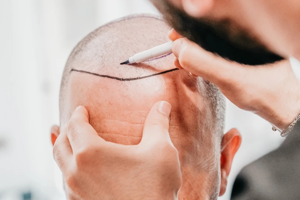 Saç Ekimi Hakkında Merak Edilen 10 Soru