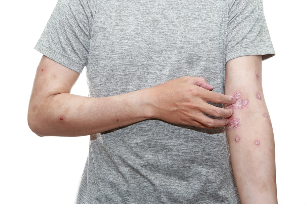 Sedef Hastalığında Bağışıklık Sistemi Neden Bu Kadar Önemli?